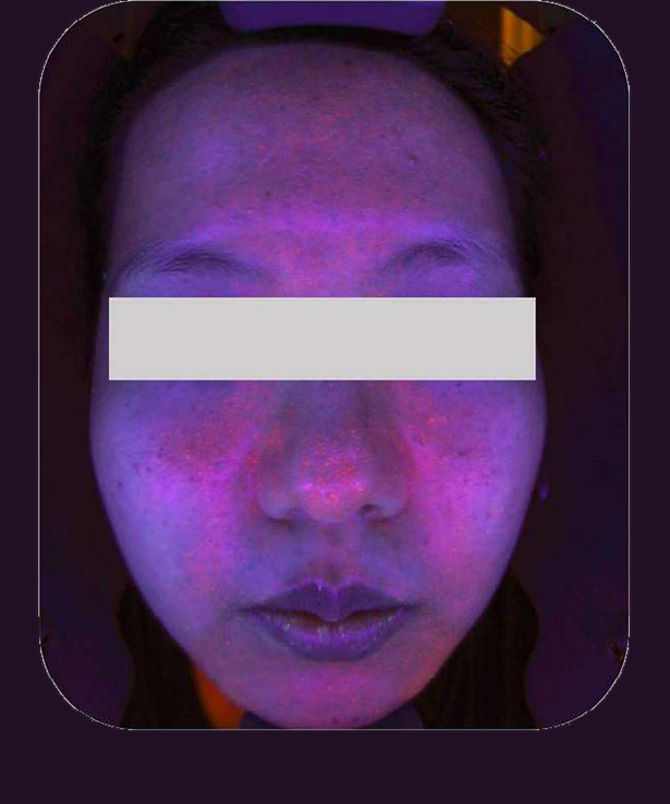 Rosto feminino sob luz ultravioleta, com pontos fluorescentes distribuídos pela pele