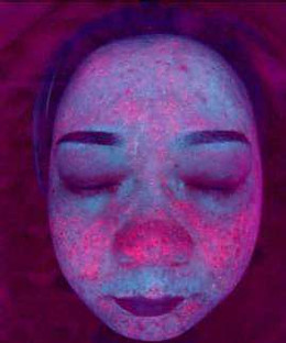 Rosto feminino sob luz ultravioleta, com pontos alaranjados de porfirina espalhados pela zona central
